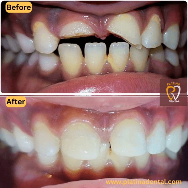 teeth bonding -5 (1)