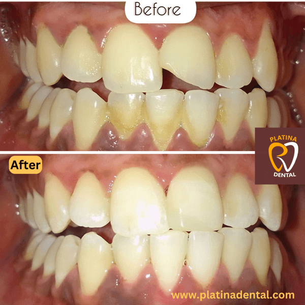 teeth bonding -6 (1)