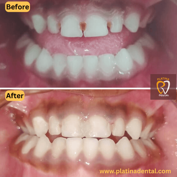 teeth bonding -7 (1)