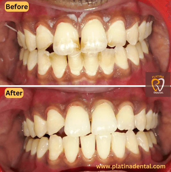teeth cleaning -1 (1)