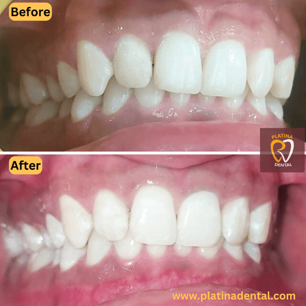 teeth cleaning and laser (1)