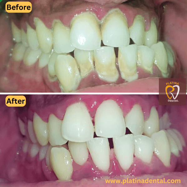 teeth cleaning and laser (2) (1)