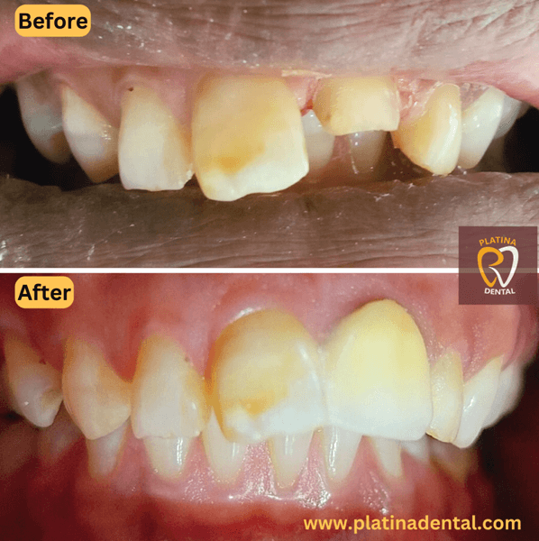 zirconia crown - 2 (1)