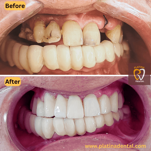 zirconia crowns -1a (1)