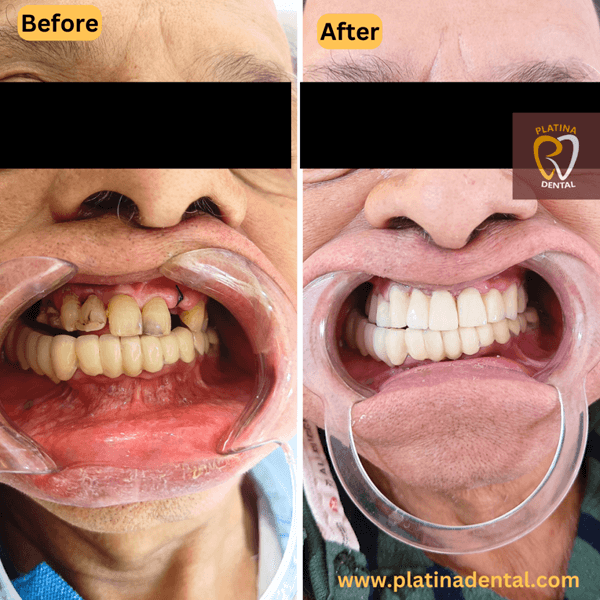 zirconia crowns -1b (1)