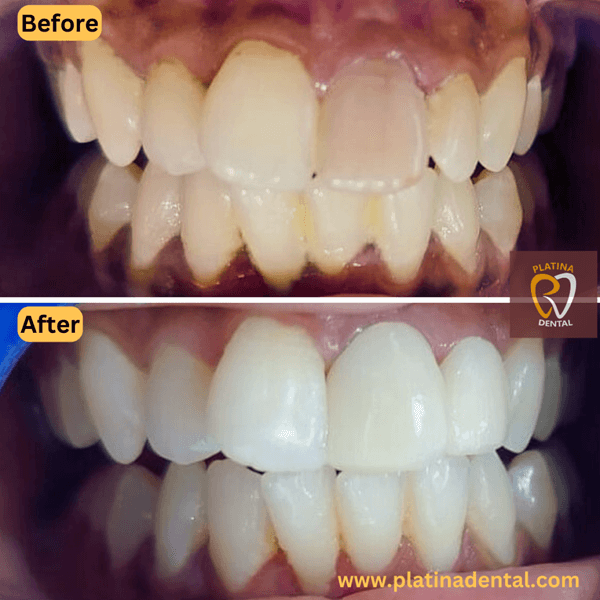 zirconia crowns -4 (1)