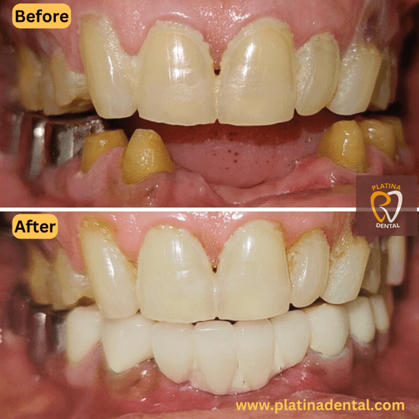 zirconia crowns -5 (1)